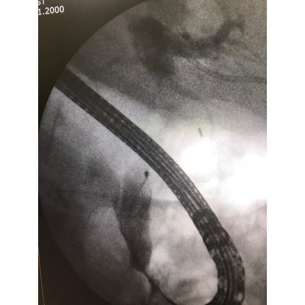 Контрольная холангиофистулография и ревизия холедоха корзинкой Дормиа