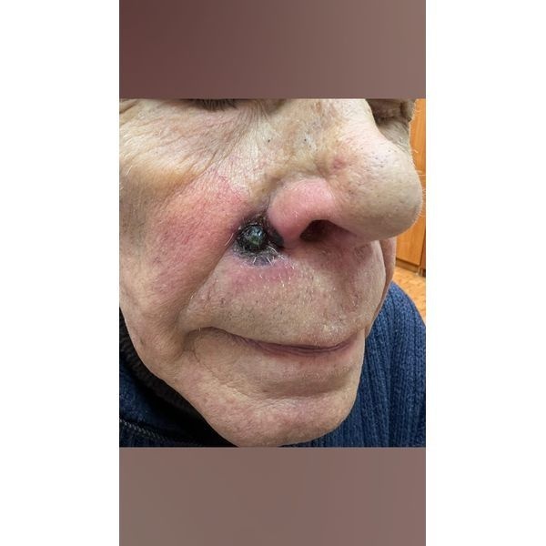 Состояние на 5-й день после ФДТ 