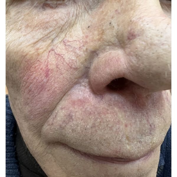 Результат через 2 месяца после лечения