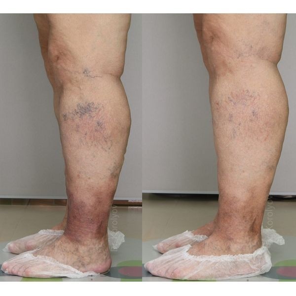 До и после лечения