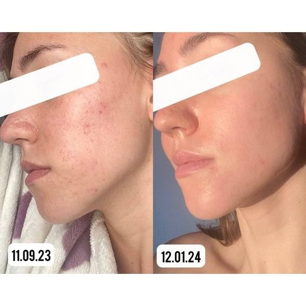 До и после лечения