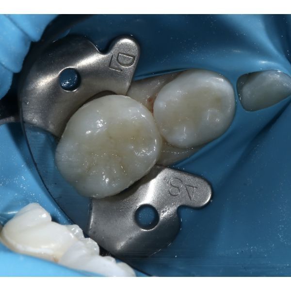 Зубы до лечения