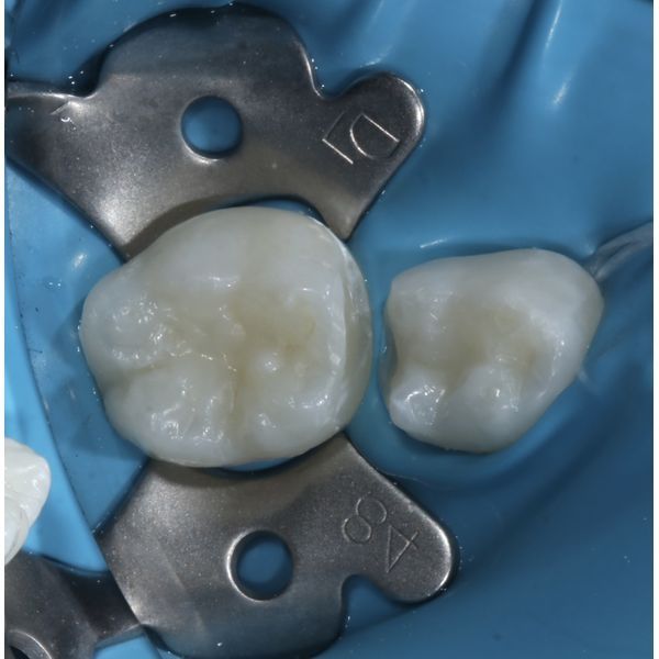 Изоляция зубов кофедрамом