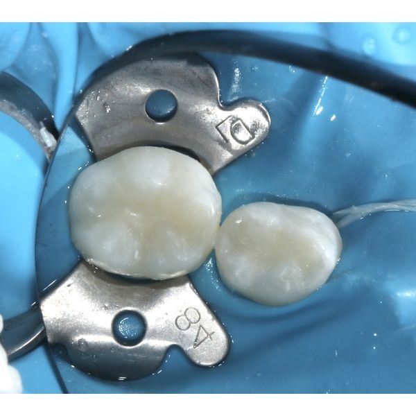 Зубы после лечения