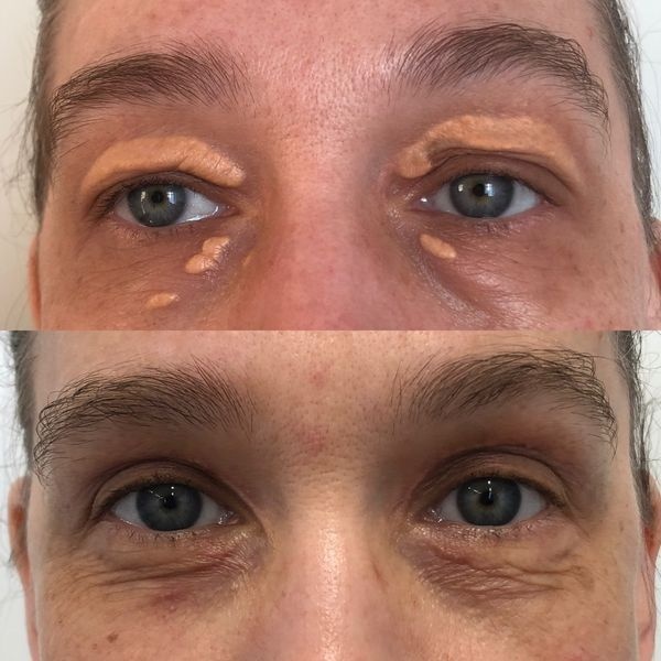 До и после лечения