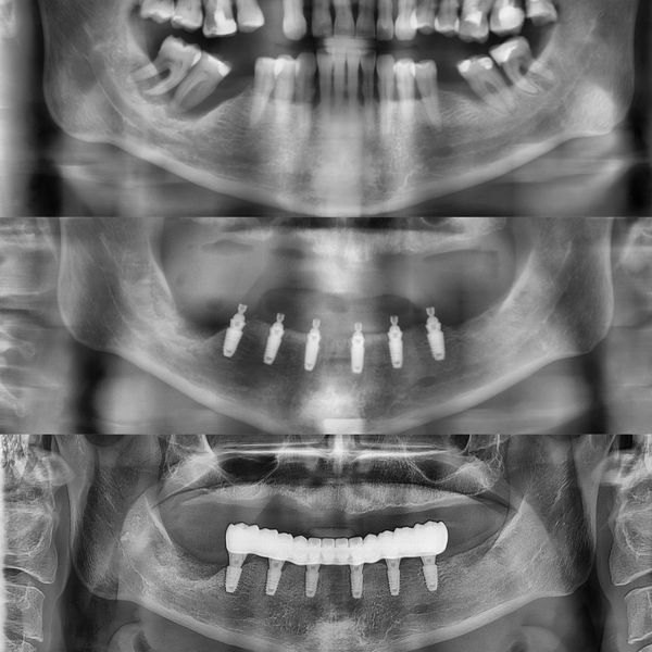 Снимок установленных протезов