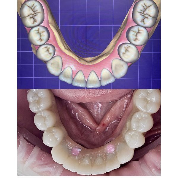 Импланты нижней челюсти