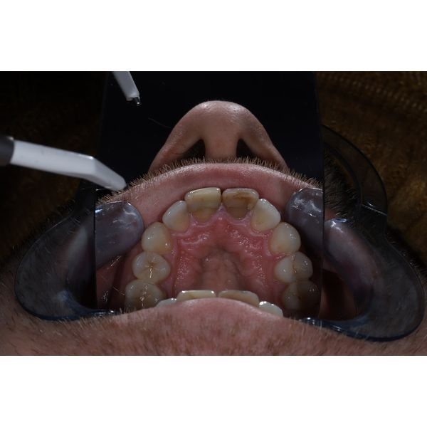 До лечения, вид снизу До лечения, вид снизу