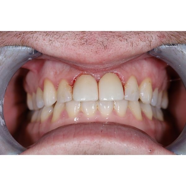 После лечения После лечения