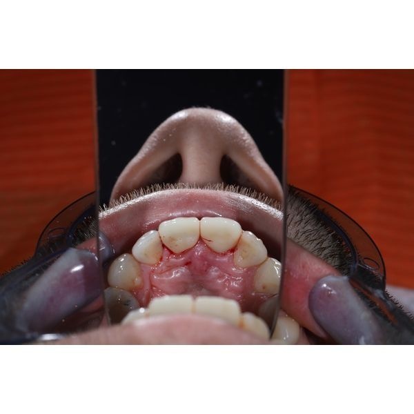 После лечения, вид снизу После лечения, вид снизу