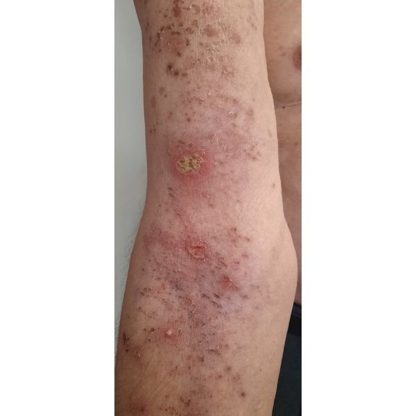 Сыпь на левой руке