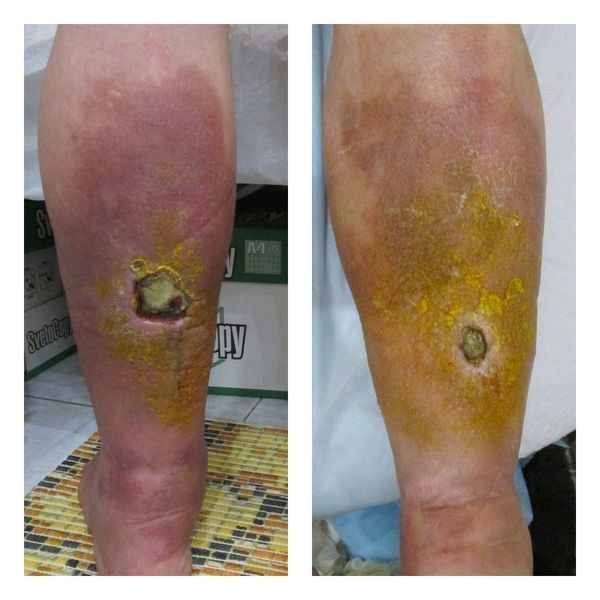 Язвы на задней и передней поверхности голени, ноябрь 2019 года