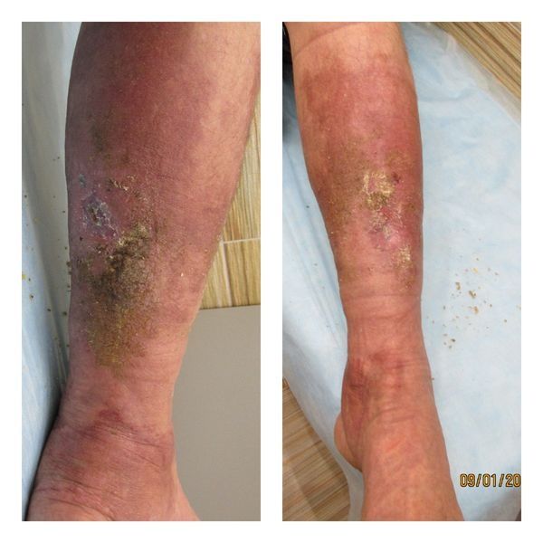 Язвы в процессе лечения, январь 2020 года