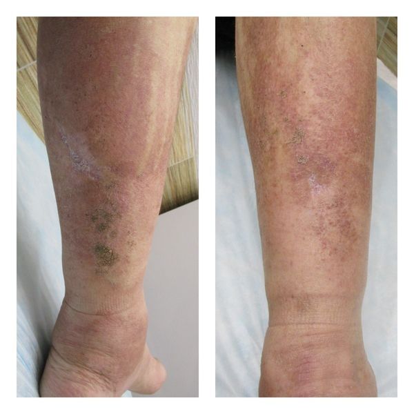 Наблюдение за пациентом после лечения, июль 2020 года