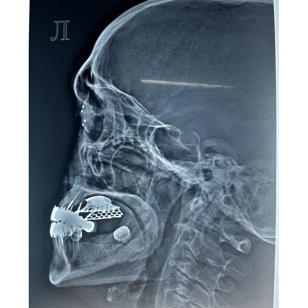Рентгенография с протезом Комберга — Балтина