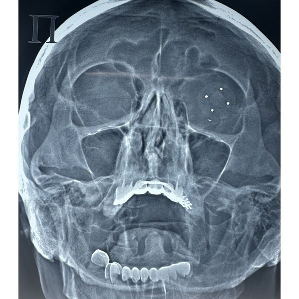Рентгенография с протезом Комберга — Балтина