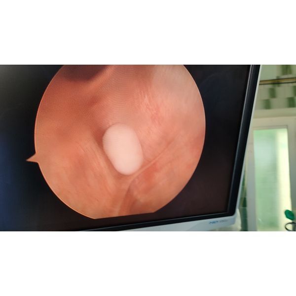 Диагностическая артроскопия