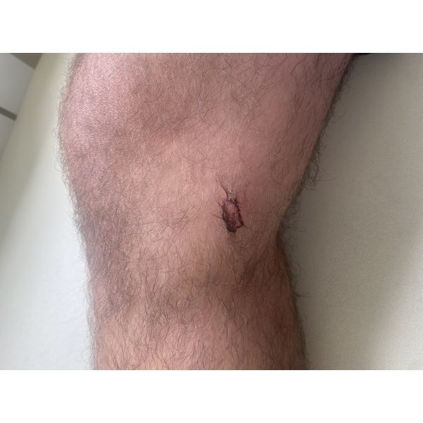 Открытая рана на внутренней поверхности колена