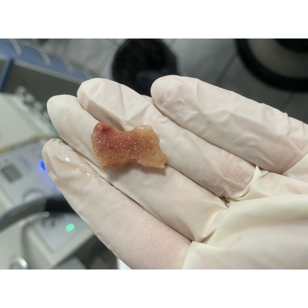 Извлечённый из полости носа кусок паралоновой губки