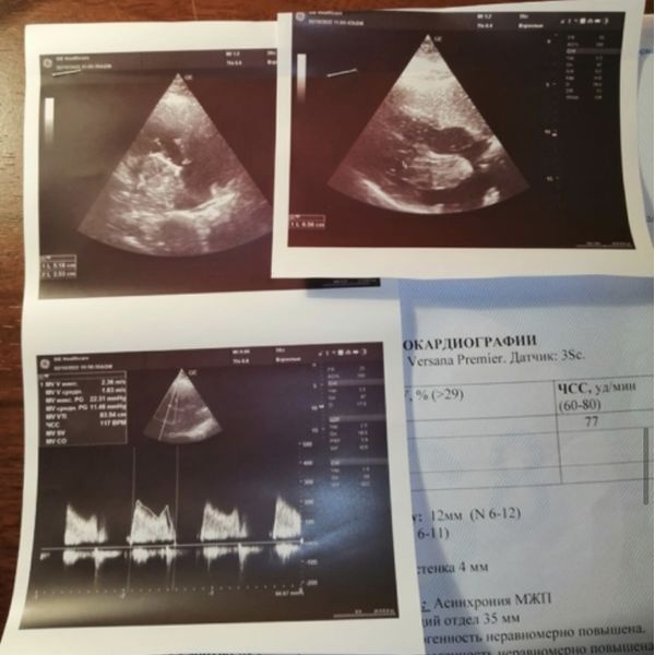 ЭхоКГ ЭхоКГ