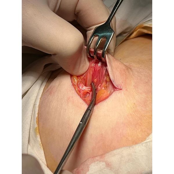 Молочная железа после удаления поражённого протока Молочная железа после удаления поражённого протока