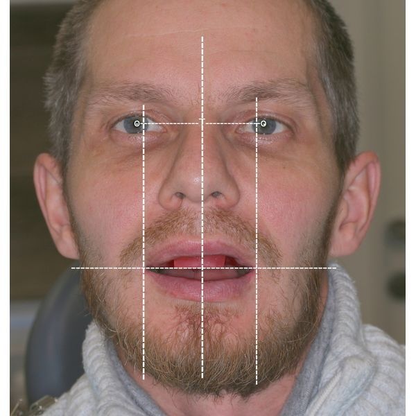 Определение анатомических параметров гармоничной улыбки 