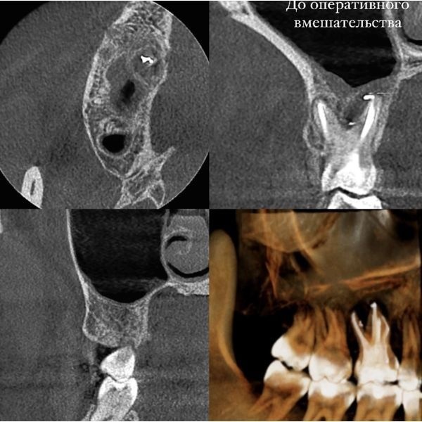 КТ-картина до лечения