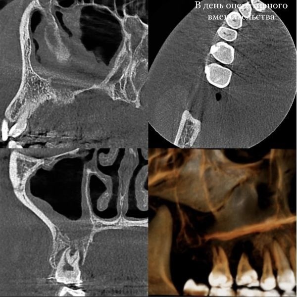 КТ-картина в день операции