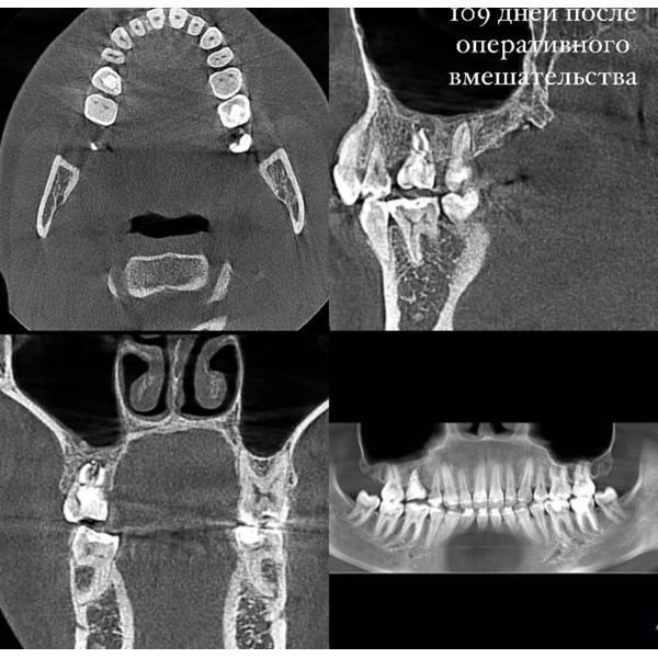 КТ-картина после лечения