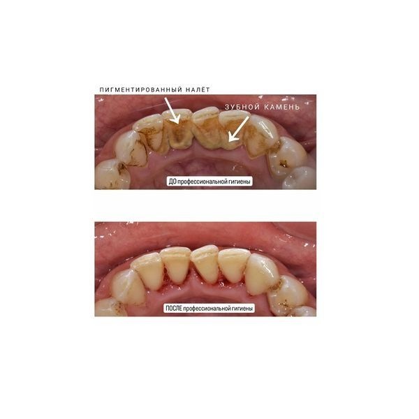 До и после профессиональной гигиены полости рта