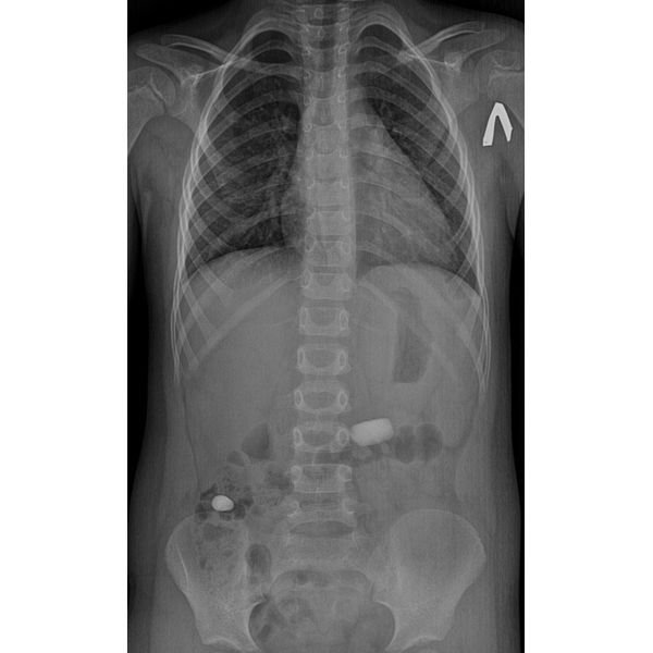 Рентгенография органов брюшной полости Рентгенография органов брюшной полости