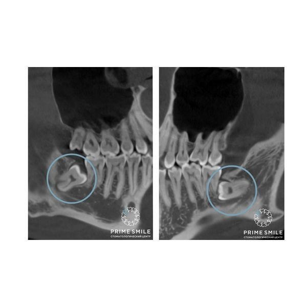 Нижние зубы мудрости до лечения Нижние зубы мудрости до лечения