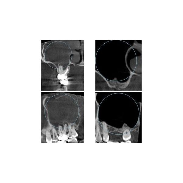 Костная полость до и после лечения