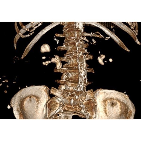 МСКТ почек до начала лечения