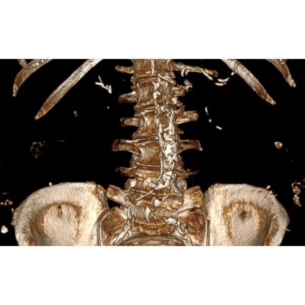 МСКТ почек через 4 месяца после лечения