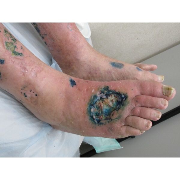 Правая стопа до начала лечения