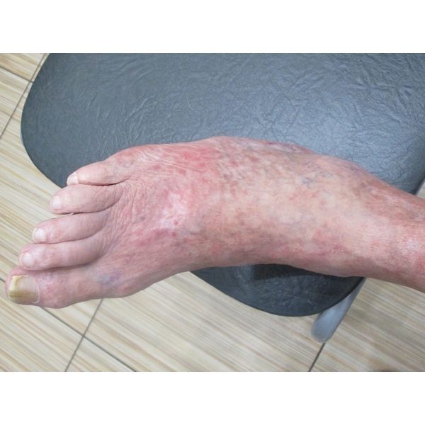 Правая стопа через 1 год от начала лечения