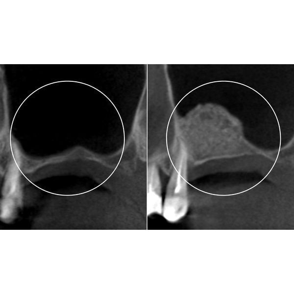 До и после проведения открытого синус-лифтинга 