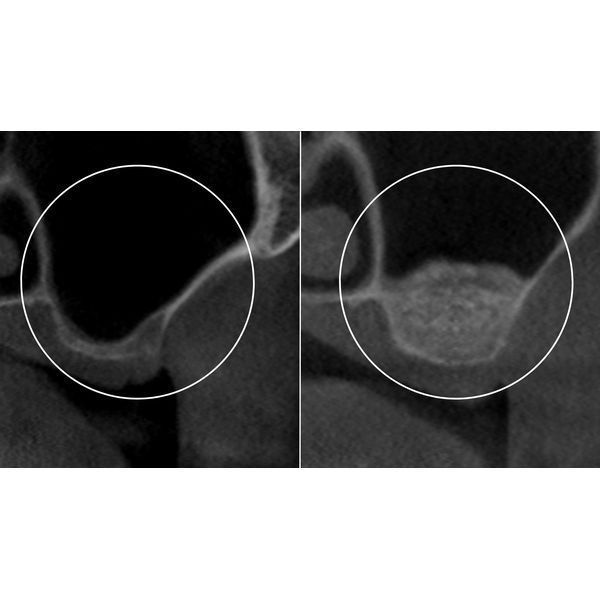 До и после проведения открытого синус-лифтинга