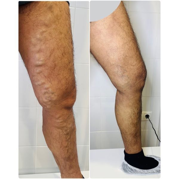 Варикозные вены до операции и через 45 дней после лечения 