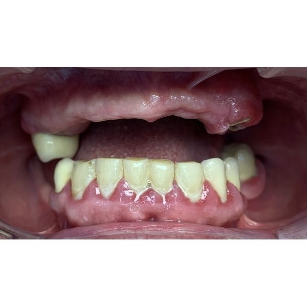 Отсутствие большинства зубов