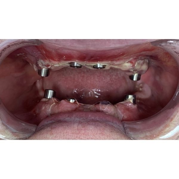 Установка мультиюнитов