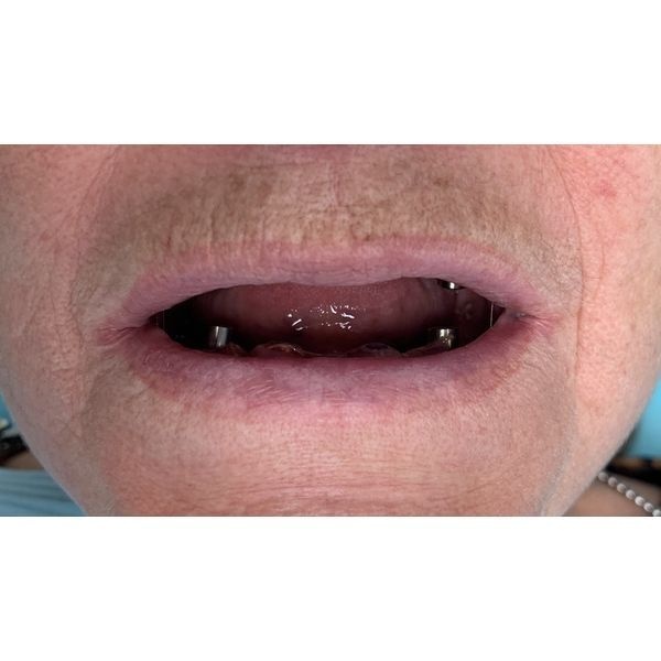 После имплантации