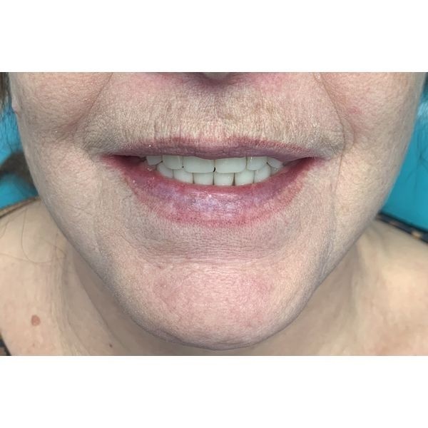 Установка постоянного протеза