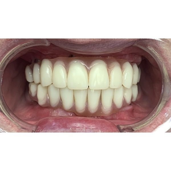 Установка съёмной конструкции