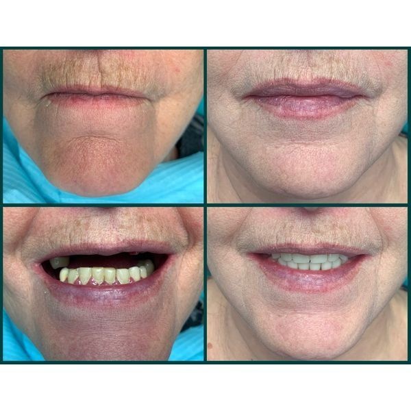 До и после лечения