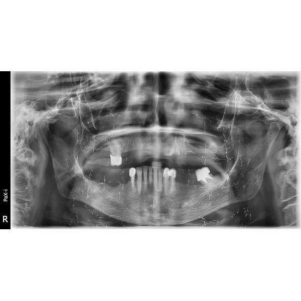 Томограмма до лечения