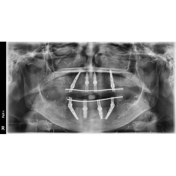 Томограмма через 3 месяца после имплантации