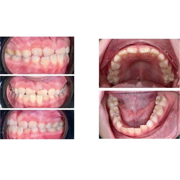 Зубы до лечения