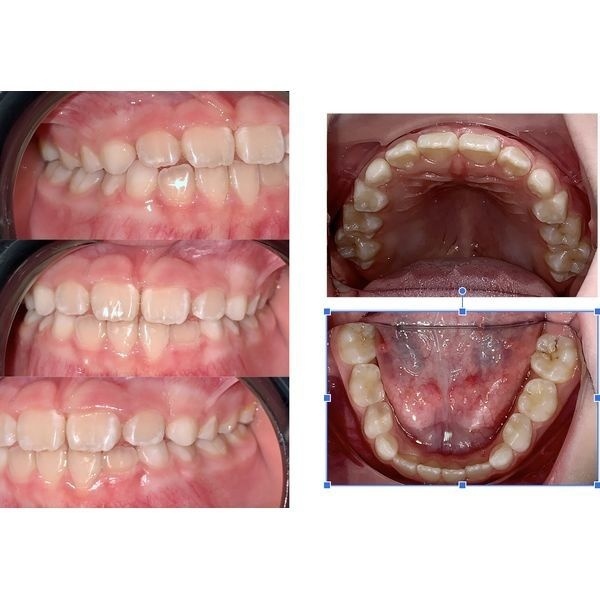 Зубы после окончания лечения